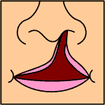 unilateral complete cleft lip/palate