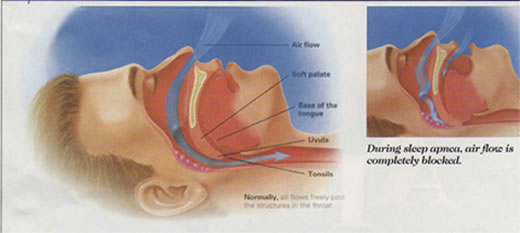 sleep apnea treatment