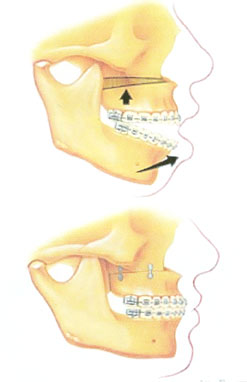 Jaw Surgery for Underbite, Overbite, Crossbite, Bad Bite - Cleft Lip and  Palate Surgery - Jaw Surgery in India - Mumbai, Maharashtra